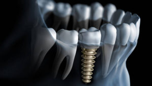 Dentys fogászati implantáció