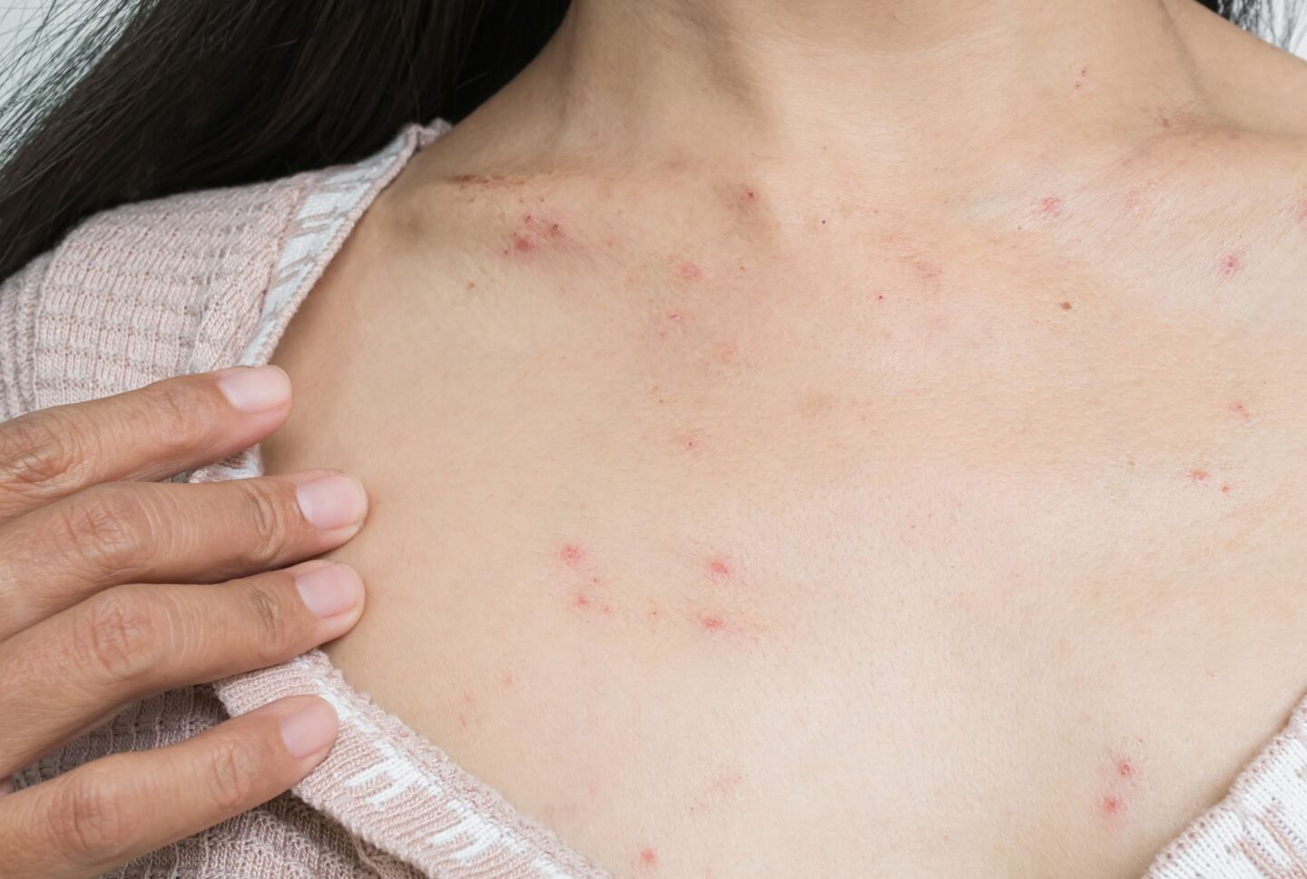 Fogászati allergia esetén viszketés is előfordulhat