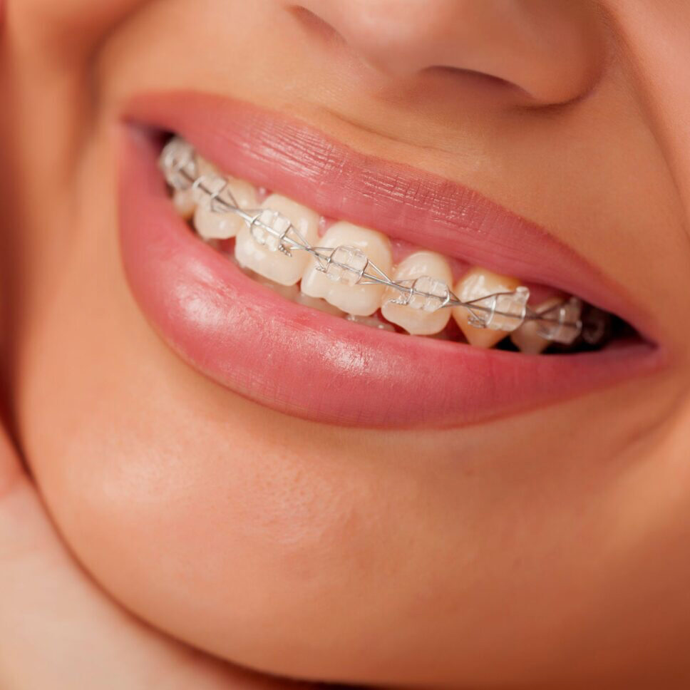 fogszabalyozo2 e1760125513200 DENTYS - Fogászat Győr