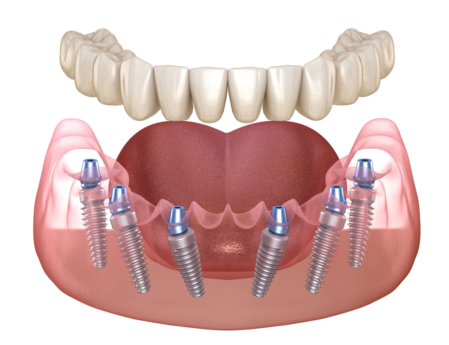 iStock 1154324664 eredmeny Fogimplantátumok Győrben a Dentys fogászatban