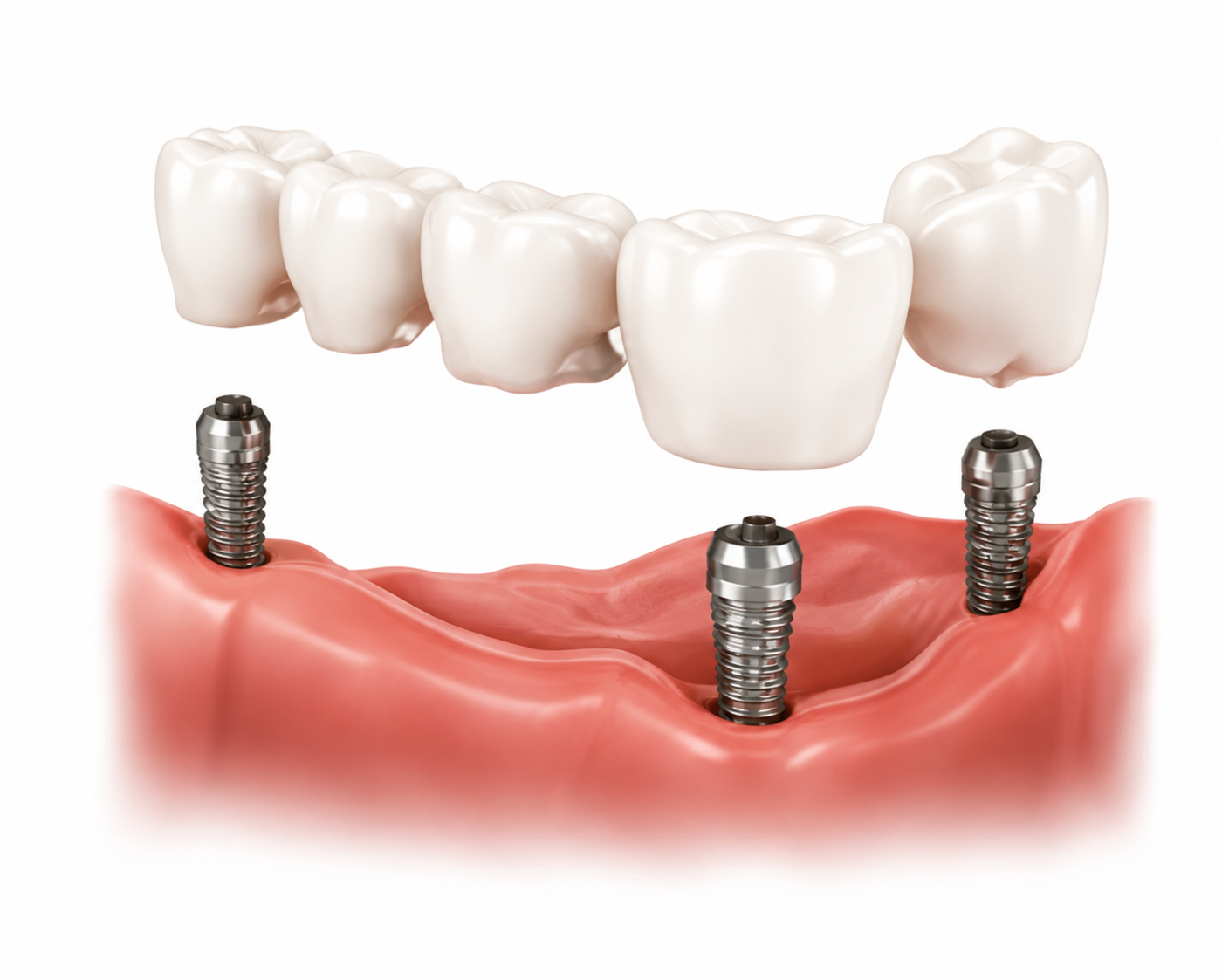 implant_kép implant kep Implantátum és rögzített fogpótlás digitális tervezéssel